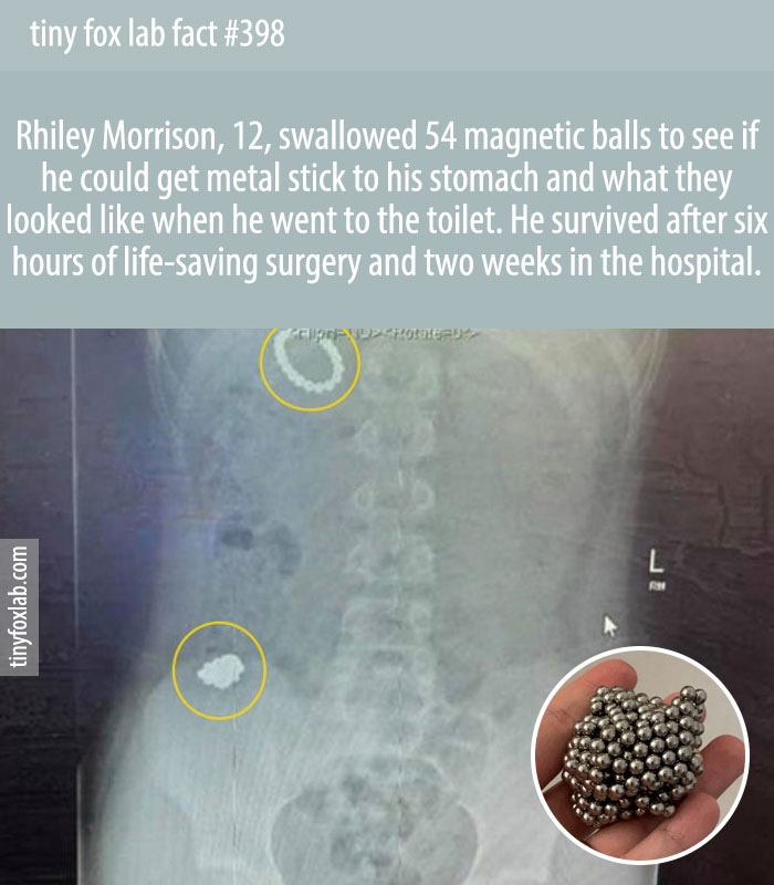 Rhiley Morrison, 12, swallowed 54 magnetic balls to see if he could get metal stick to his stomach and what they looked like when he went to the toilet.